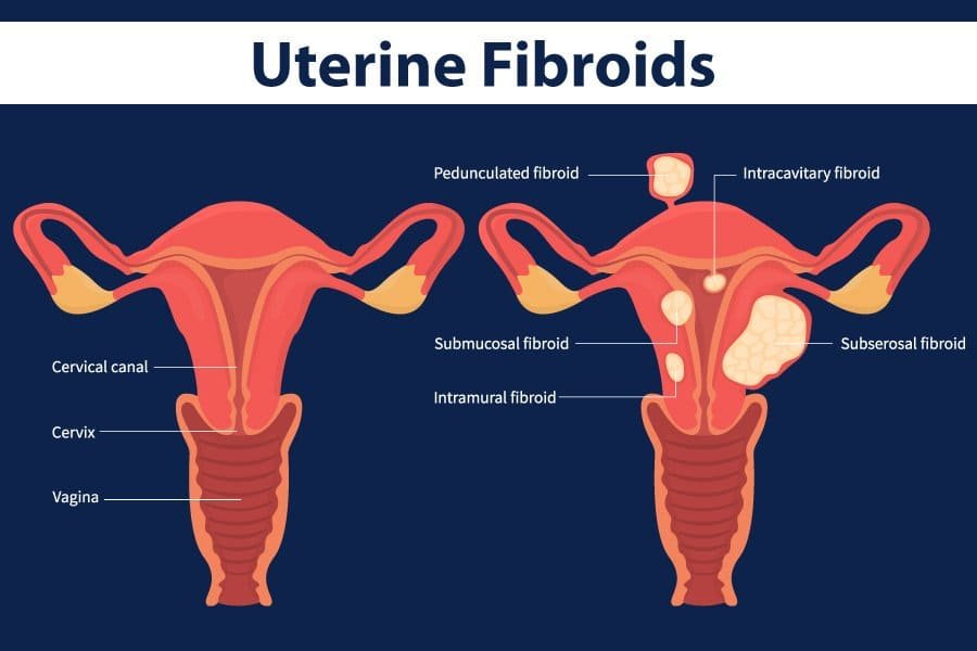 blog-uterine-fibroids.jpg